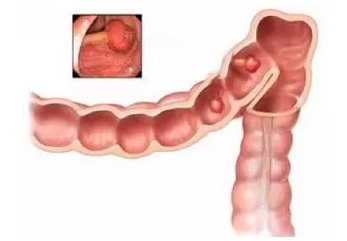 没胃口拉肚子消瘦齐出现 警惕直肠癌