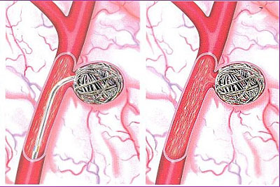 脑血管动脉瘤突然破裂 可是冬天泡脚惹的祸?