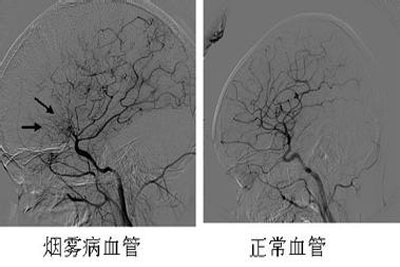 突发脑出血险失明 竟是“烟雾病”作怪