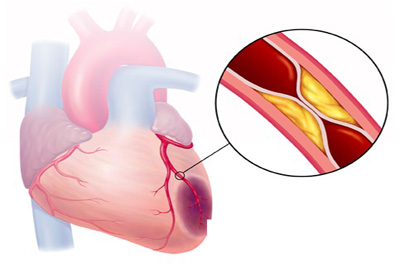 犟老人忍受6年胸痛不治疗 突发心梗倒地