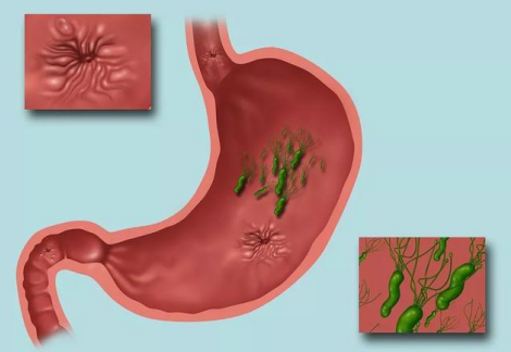 久杀不灭的幽门螺杆菌有了新克星,并获国家专利