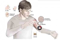 半小时700个俯卧撑 过猛运动致横纹肌溶解