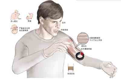横纹肌溶解综合征 横纹肌溶解综合征