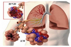 右肺2/3以上呈黑色 原是肺大疱作怪