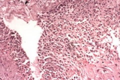 小伙笑到爆肺 罪魁祸首竟然是肺大疱