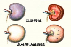 感冒药混搭吃 吃成急性肾衰竭