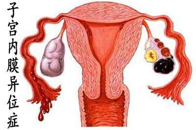 子宫内膜异位症