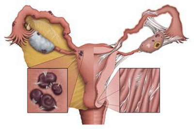治疗子宫内膜异位症的药