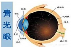 女童右肢偏瘫青光眼 经查患血管瘤
