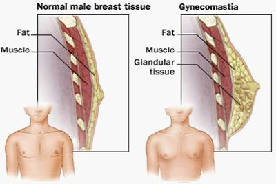先天性肾上腺皮质增生症