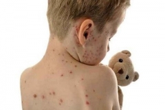 春季幼儿水痘高发 预防谨记四措施