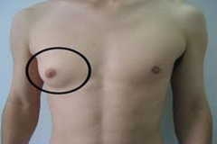 男子左侧乳晕下方有硬块,原是乳癌