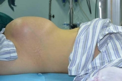 体检发现长足球大小肿瘤 原是嗜铬细胞瘤