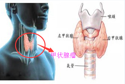 甲状腺瘤