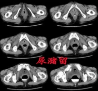 6旬老人肚子时大时小 原来是得了尿潴留