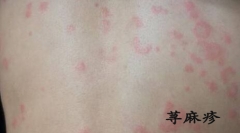 春季荨麻疹 或许该试试中医