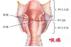 老烟民声沙两年 原是喉癌作怪