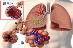 肺气肿患者福利 中医治疗偏方来了