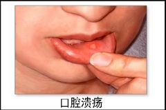 令人头疼的口腔溃疡 让你“张”不开嘴吃不下饭