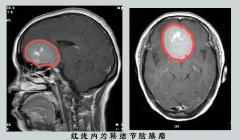 左眼失明后右眼视力也下降 检查发现是脑膜瘤