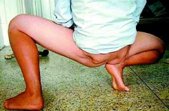 屁股针打多了 可能会得“臀肌挛缩症”