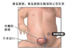 幼儿患先天性膀胱外翻  诊断方法不可忽视