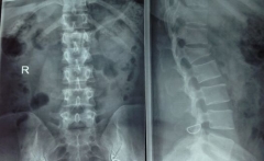 节日拥抱太激烈 居然出现腰椎骨折