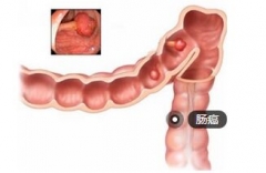 二胎妈妈查出肠癌晚期 宝宝至今未见一面