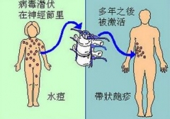 头痛后身上长红色水泡 警惕带状疱疹神经痛