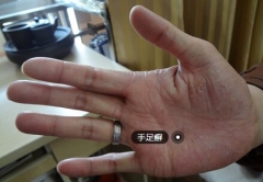 手足癣不难治 关键在于选对方法