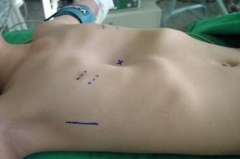 从小就有的漏斗胸 让他驼着背直不起腰来