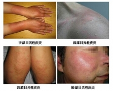 日晒后皮肤出了小红疹 小心日光性皮炎