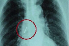 假牙遗落在肺里 导致老太持续咳嗽咳痰