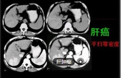 体重骤降胃口不好 原是肝里长巨瘤