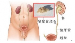 不好生活习惯染上结石病 看看你中了几枪?