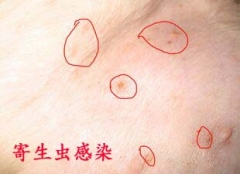 左腿肿起鸽子蛋大的包 检查得知是寄生虫感染