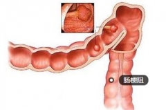9旬老太腹胀腹痛 因肠梗阻一度命悬一线