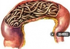 囫囵吞枣大吃木耳 造成急性肠梗阻