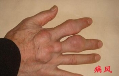 痛风后没有禁酒 结果出现痛风性关节炎