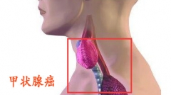 儿童喉结越来越突出 警惕甲状腺癌