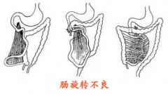 10多年莫名腹胀呕吐 小心肠旋转不良