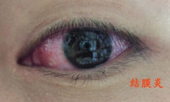 眼睛痒还红彤彤泪汪汪 原是得了结膜炎