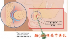 张大嘴巴吃东西就痛 警惕颞颌关节紊乱