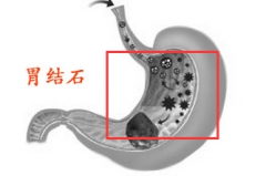 一口子吃十多个柿子 半年后出现胃结石