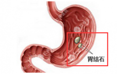爱吃山楂禁不住嘴 结果吃出胃结石