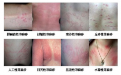 用了新凉席身上现红疹且奇痒无比 原是荨麻疹