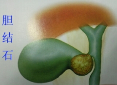 宝宝大便变白色 原是胆结石堵住胆道