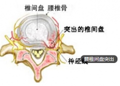 腰又酸又痛 警惕腰椎间盘突出