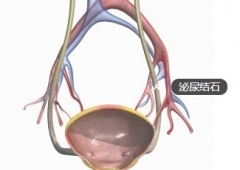 前列腺肥大易引发泌尿结石 饮食禁忌需注意
