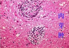 腹股沟长肿块 竟是活体寄生虫引起的肉芽肿